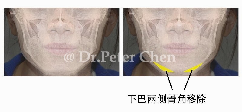 自體骨下巴手術-墊下巴-削骨
