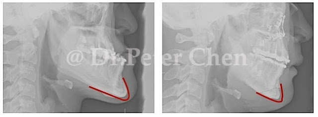 正顎-削骨-墊下巴